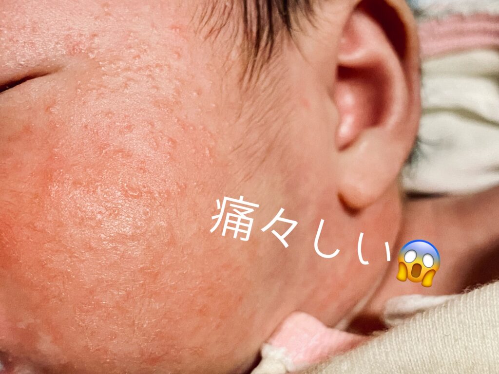 【1m】乳児湿疹で全身ブツブツになったので入浴とケアを見直しました